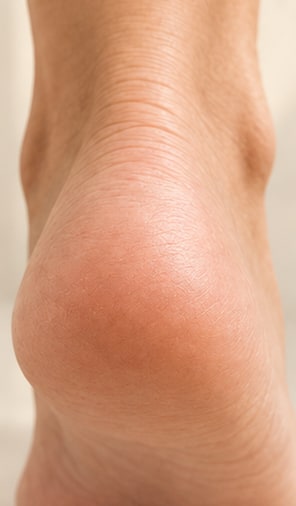 The same heel looking smooth and soft after using the foot file